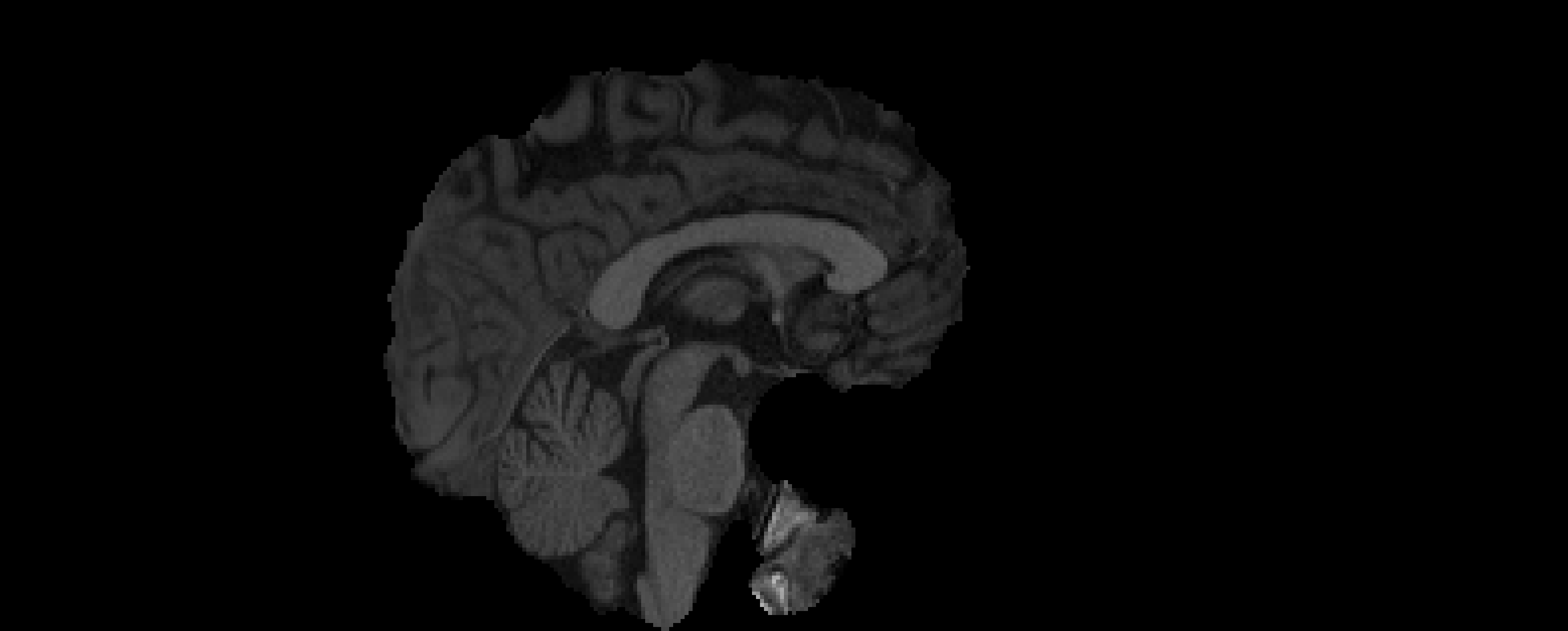 Skull-Stripped Brain