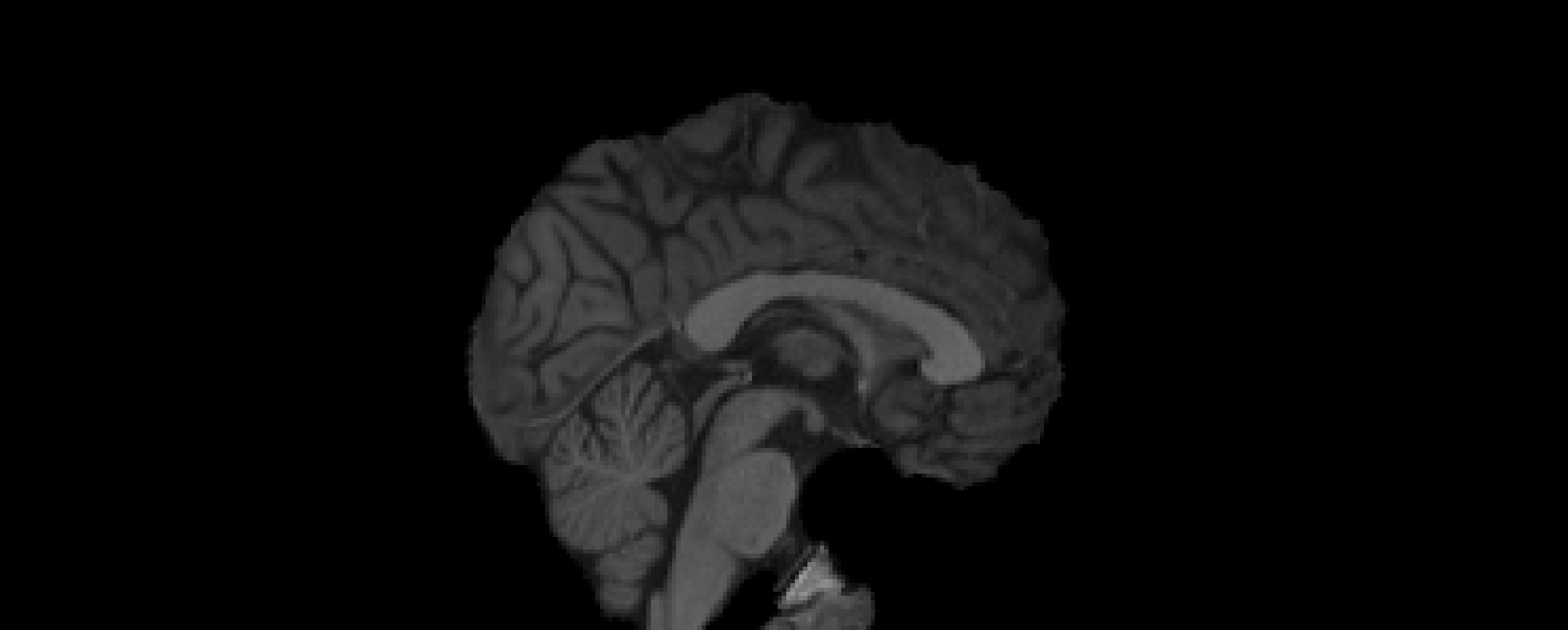 6 DOF to MNI (1mm)