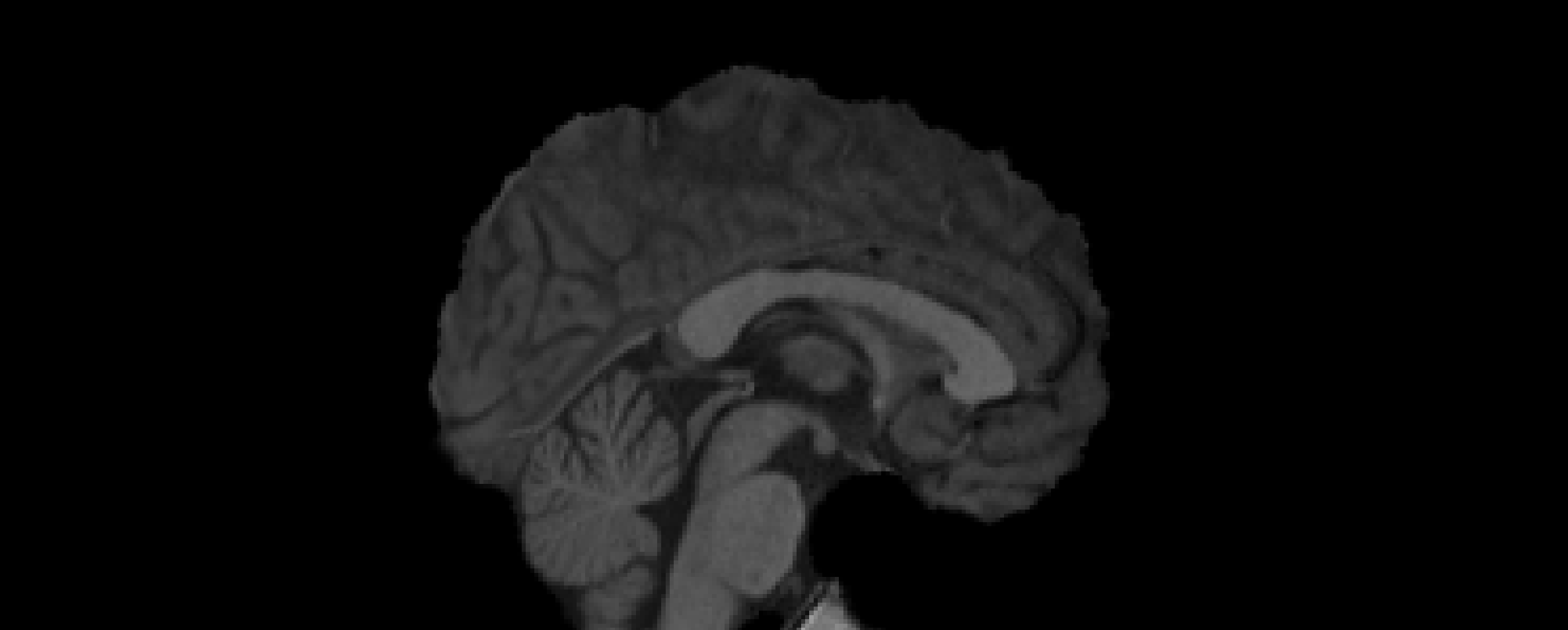 12 DOF to MNI (1mm)
