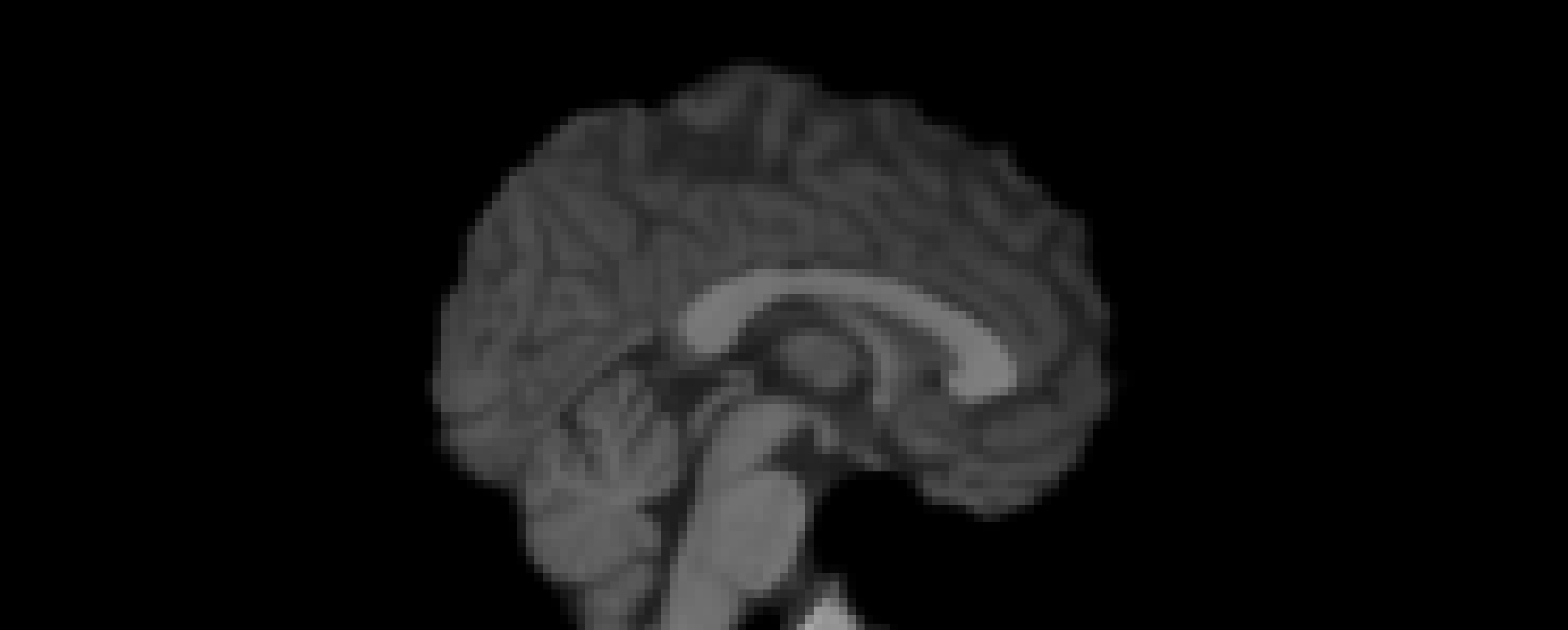 White Stripe Normalized T1w